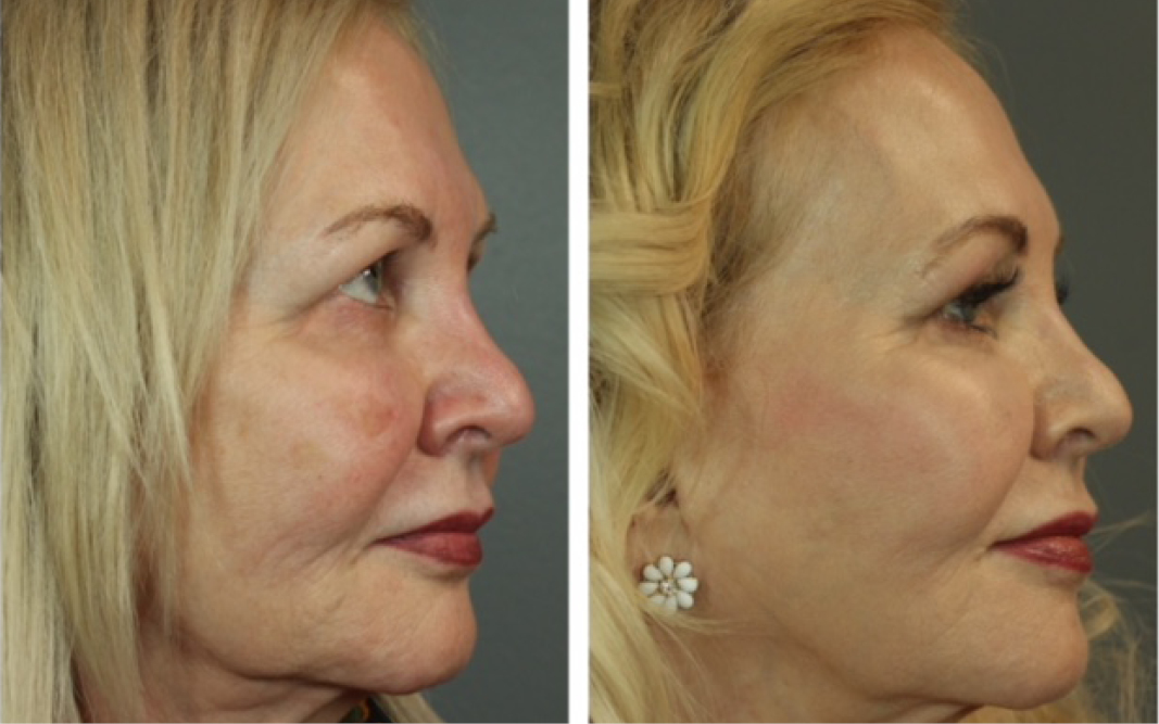 Profound RF Before and After